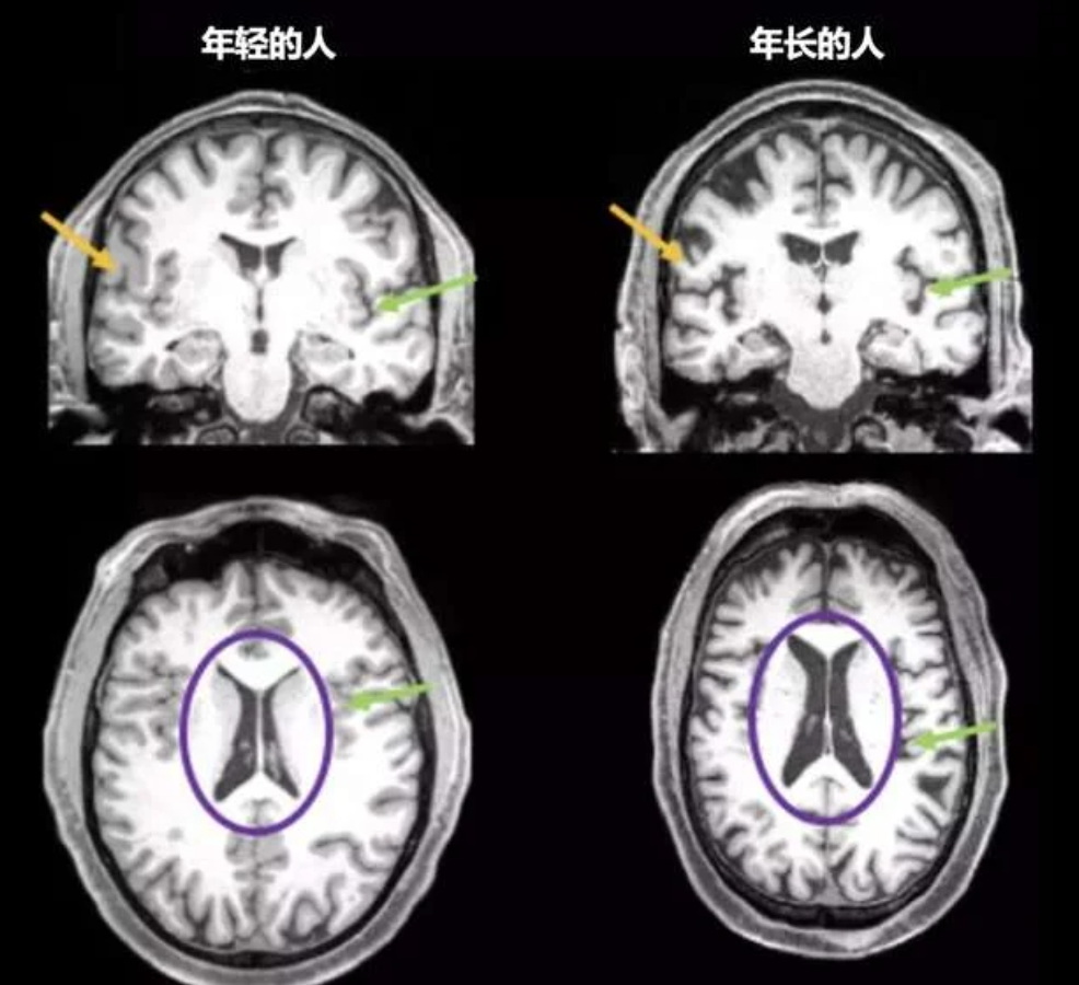 新冠病毒的刺突蛋白可能会长期残留在感染者的大脑中 新冠病毒的刺突蛋白可能会长期残留在感染者的大脑中